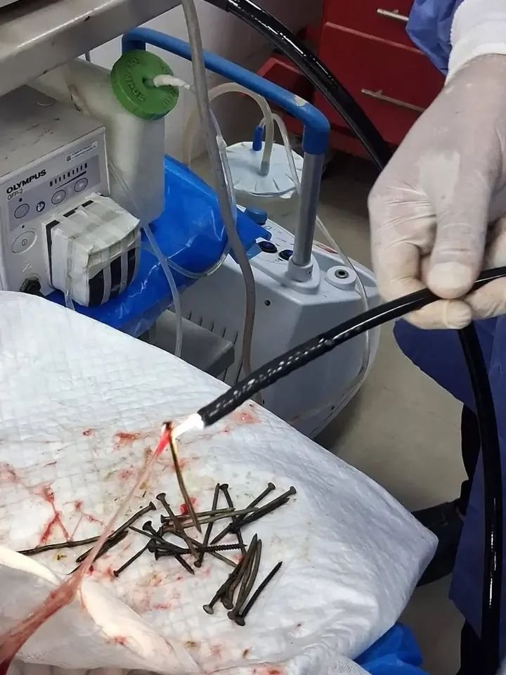إستخراج 100مسمار من بطن صعيدى دون جراحة